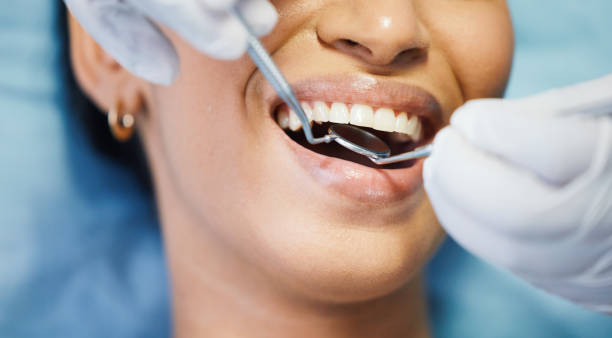 Best Knocked-Out Tooth (Avulsed Tooth) Treatment in Durant, OK